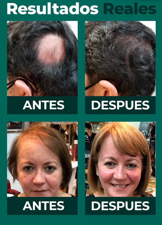 DHT Blocker - La Solución Natural Que Detiene la Caída Capilar