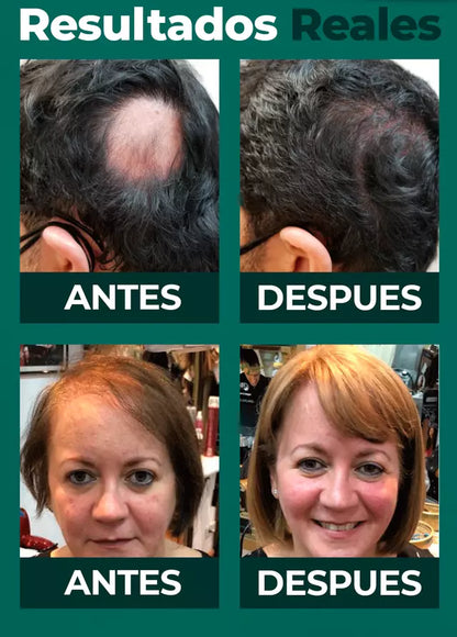 DHT Blocker - La Solución Natural Que Detiene la Caída Capilar